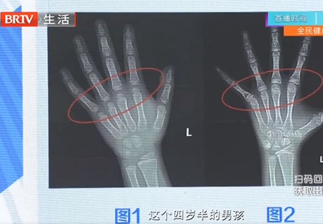 天博tb综合体育吃一口等于吃10个塑料袋？3种食物别给娃吃了已有孩子停止发育